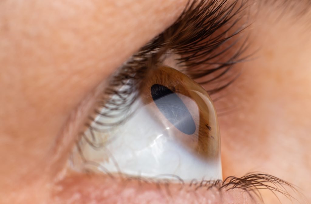 A close up of a person's cornea that is developing into a cone shape, known as Keratoconus
