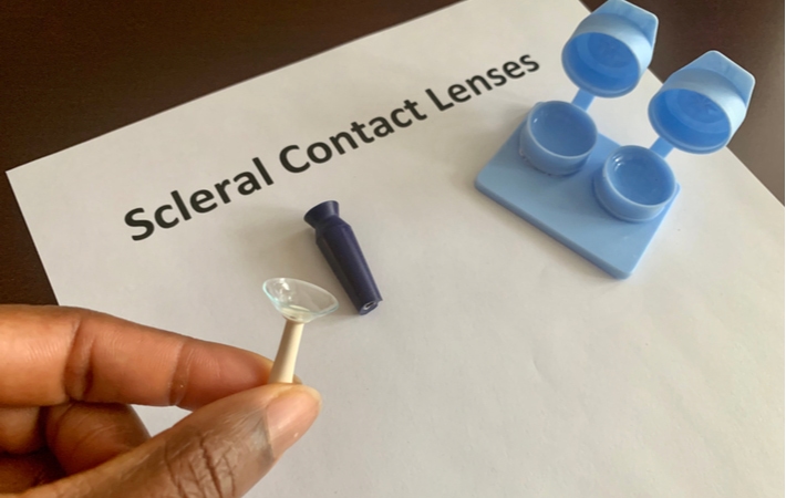 A person holding up a scleral contact lens to assist with someone with advanced Keratoconus