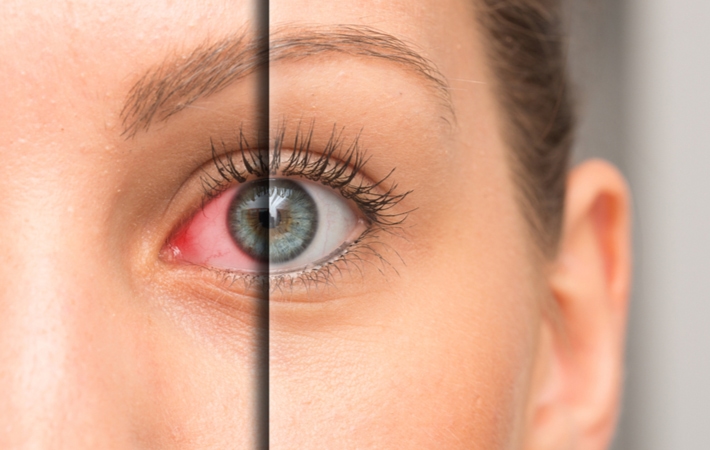 A before and after comparison of what an eye can look like when suffering from dry eye syndrome