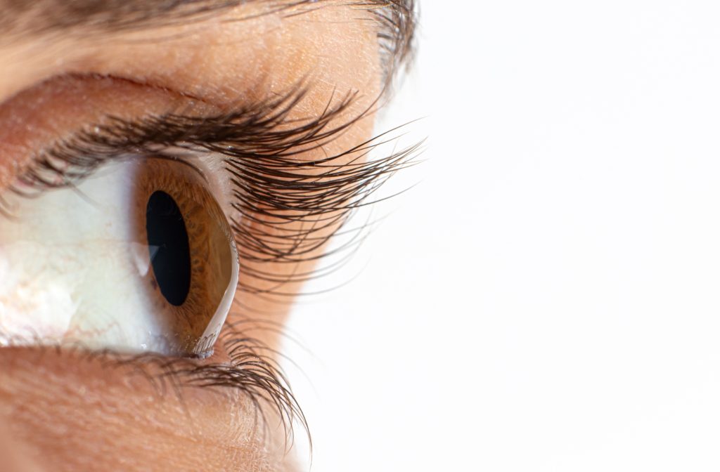 A close up view of a person with Keratoconus in their eyes