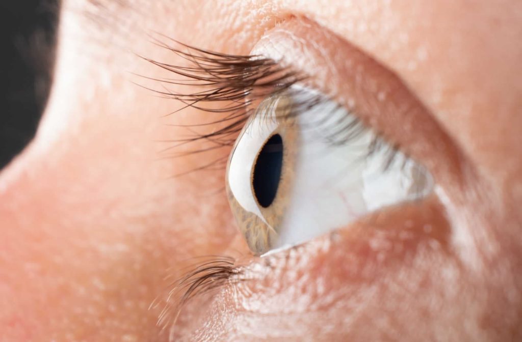 A close up of an eye with keratoconus showing how the cornea is irregularly shaped